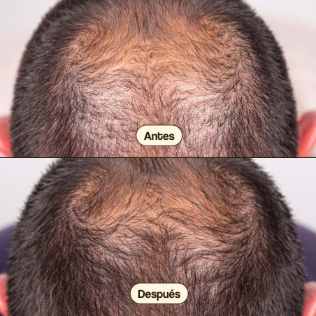 Hair Growth & Density Treatament